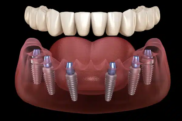 All-on-X Implants